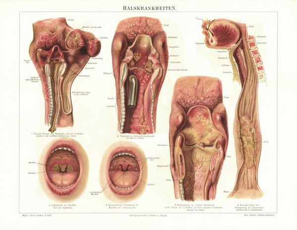 Halskrankheiten. Lithografie von 1895