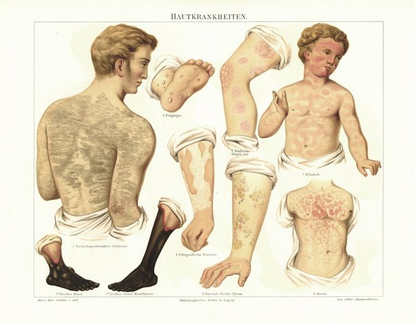 Hautkrankheiten. Lithografie von 1895